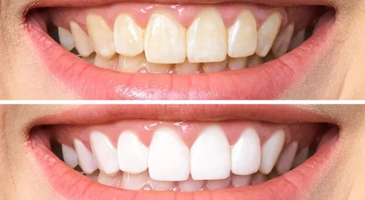 ТОП-15 способов улучшения улыбки: отбеливание зубов и другие методы