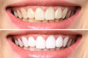 ТОП-15 способов улучшения улыбки: отбеливание зубов и другие методы